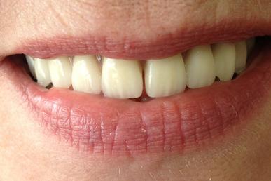 Patient Michel Puertas Denturologiste Brossard-Laprairie