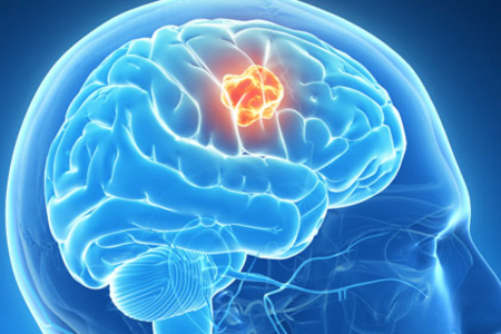Neoplasim Brain Tumor - Dr. Joel Wallach