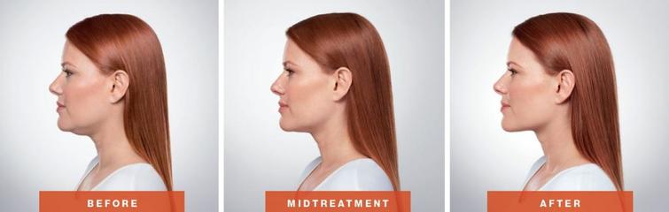 Cosmetic Injectables Center, Encino, Sherman Oaks Botox, Fillers, Restylane, Juvaderm, Kybella, Chin fat, armpit fat