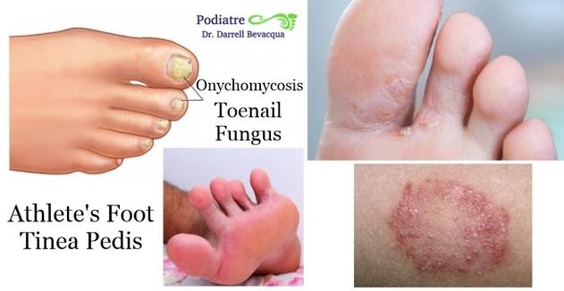 Sally's Foot Clinic - Athlete's foot (tinea pedis) is a fungal