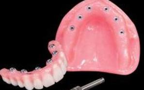 Prothèse Dentaire Fixe Sur Implants Michel Puertas Denturologiste Brossard-Laprairie, Fixed Denture On Implants Michel Puertas Denturologiste Brossard-Laprairie