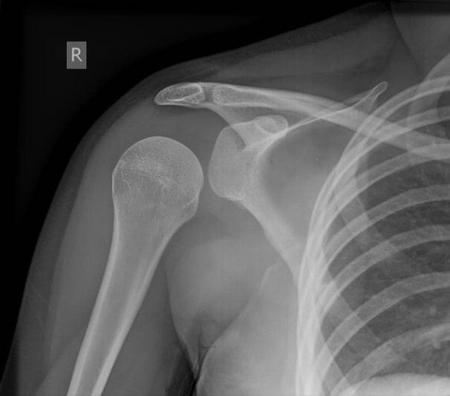 JOINT DISLOCATION AND SUBLUXATION – Types, Causes and Risk Factors, Clinical Manifestations, Diagnostic Test, Medical and Nursing Management