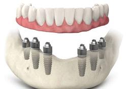 Prothèse Dentaire Sur Implants Fixe Fix-On-6 Brossard-Laprairie