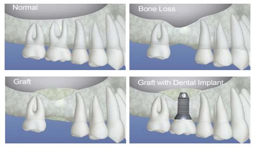 dental bone graft dental sinus graft Brossard-Laprairie