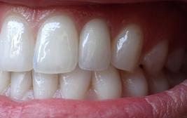 Fixed Denture On Implants Brossard-Laprairie