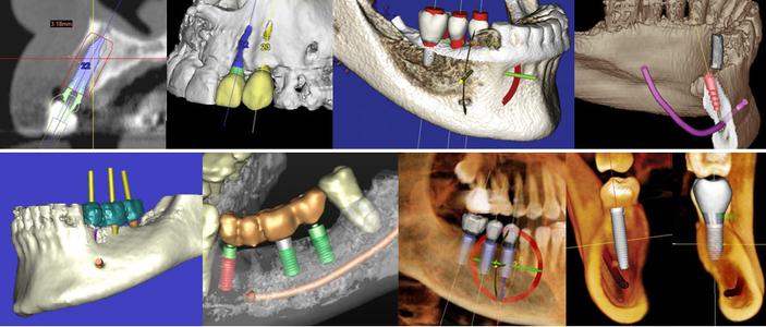 Scan 3D Clinique Implantologie Dentaire Brossard-Laprairie
