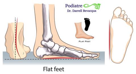 Flat feet and knee pain