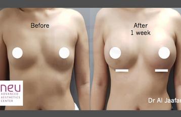 Breast implants before and after photos