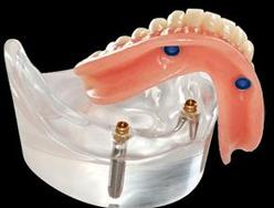 Prothèse Dentaire Sur Implants Michel Puertas Denturologiste Brossard-Laprairie, Denture On Implants Michel Puertas Denturologiste Brossard-Laprairie