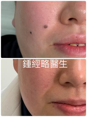 a before and after picture of removal of 2 moles on right face with no scar seen
