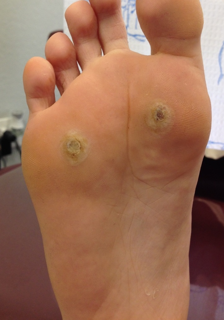 Callus Removal – Podiatry