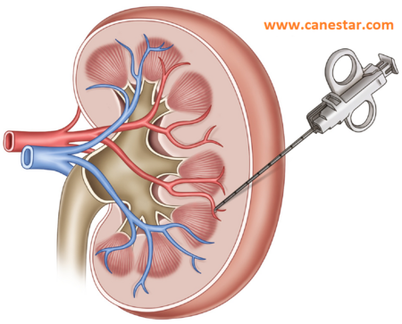 BIOPSY (Kidney) – Preparation and Procedures