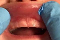 labial frenulum normal