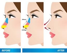 Rhinoplasty Philippines