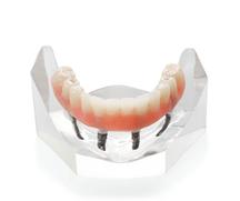 Prothèse Dentaire Fix-On-4