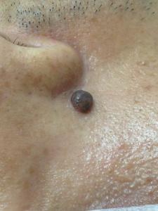 一粒位於右邊面部，接近鼻子的，凸出的，深啡色的墨痣