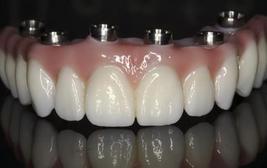 Fixed Denture On Implants Brossard-Laprairie