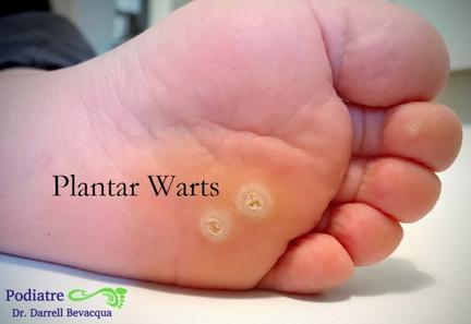 Callus removal from feet + small seed corn 