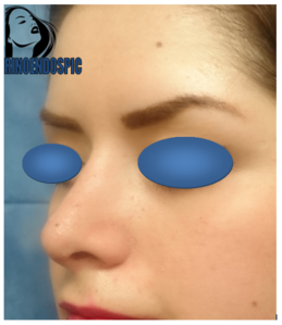 Rinoplastia después