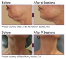 pigmentation, texture, age spots, skin, tightening, collagen, acne, encino, sherman oaks, cosmetic injectables center