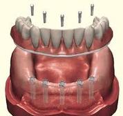 Fixed Denture On Implants Brossard-Laprairie