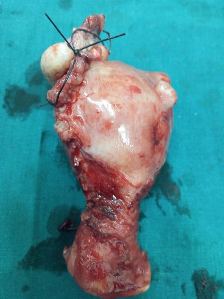 no scar uterus removal goa