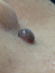 近鏡觀察這粒墨痣：凸出皮膚表面，無毛，表面光滑，呈深啡色