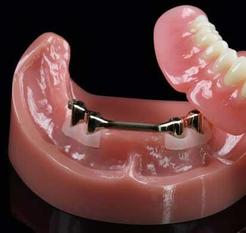 Dental complete lower denture on 4 dental implants Brossard-Laprairie