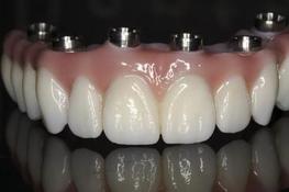 Prothèse Complète Fixe Fix-On-Zircon Brossard-Laprairie