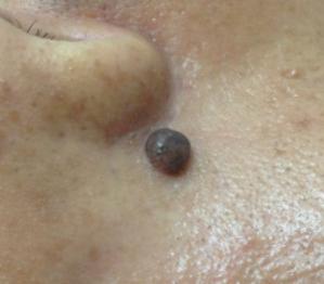 a dark brown nevus locates on the external side of the right ala