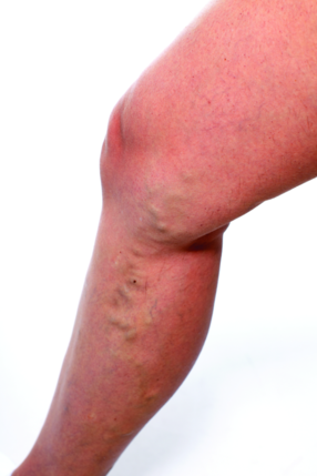 Varicose Vein Treatments, Guelph, ON