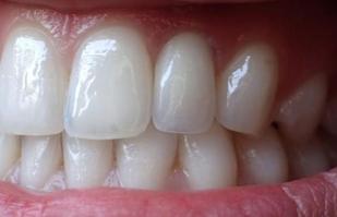 Denture Fix-On-Zircon Michel Puertas Denturologiste Brossard-Laprairie