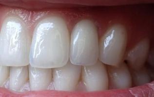 Fixed Denture On Implants Michel Puertas Denturologiste Brossard-Laprairie