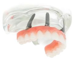 Denture On Implants Fix-On-4 Clinique Implantologie Dentaire