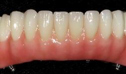 Prothèse Fixe Fix-On-Zircon Fixed Denture Fix-On-Zircon Brossard-Laprairie