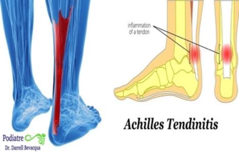 Achilles tendon pain on sale running