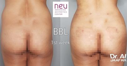 Brazilian butt lift (BBL) before and after photos