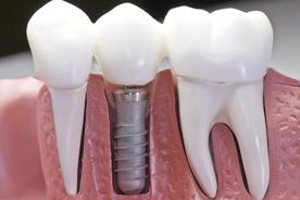 Dental crown on dental implant Brossard-Laprairie