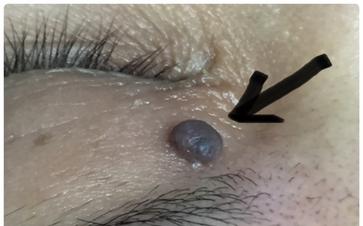 a dark brown skin mole locates on the left upper eyelid above the medial canthus