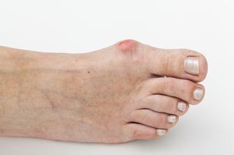 Hallux Valgus Oignon Pied Podiatre chirurgien exp riment