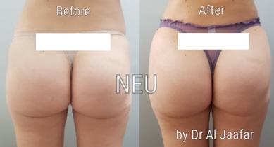 Brazilian butt lift (BBL) before and after photos