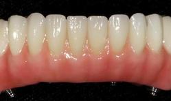 Prothèse Fixe Fix-On-Zircon Fixed Denture Fix-On-Zircon Brossard-Laprairie