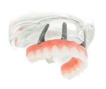 Prothèse Dentaire Fix-On-4