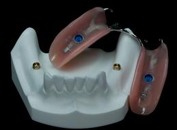 prothèse dentaire partielle du haut sur 4 implants dentaires dentier partiel sur implants Brossard-Laprairie