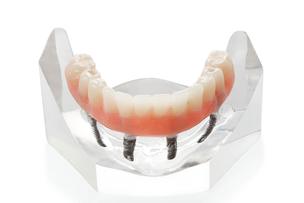 Denture Fix-On-4 Clinique Implantologie Dentaire Brossard-LaPrairie