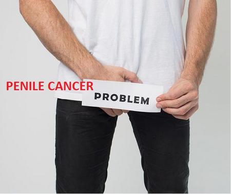 PENILE CANCER – Types, Causes and Risk Factors, Clinical Manifestations, Diagnostic Evaluations, Stages and Management