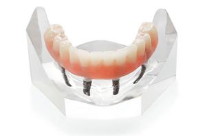 Fixed Denture On Implants Fix-On-4 Michel Puertas Denturologiste Brossard-Laprairie