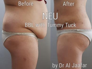 Brazilian butt lift (BBL) before and after photos