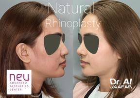 Rhinoplasty before and after photos