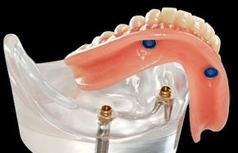 prothèse amovible sur implants Brossard-Laprairie, removable denture on implants Brossard-Laprairie